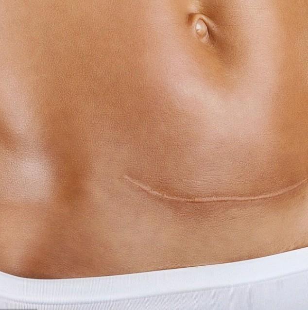 Terapie po císařském řezu